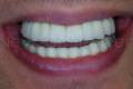 Entgültigen Zahnersatzes auf Implantaten